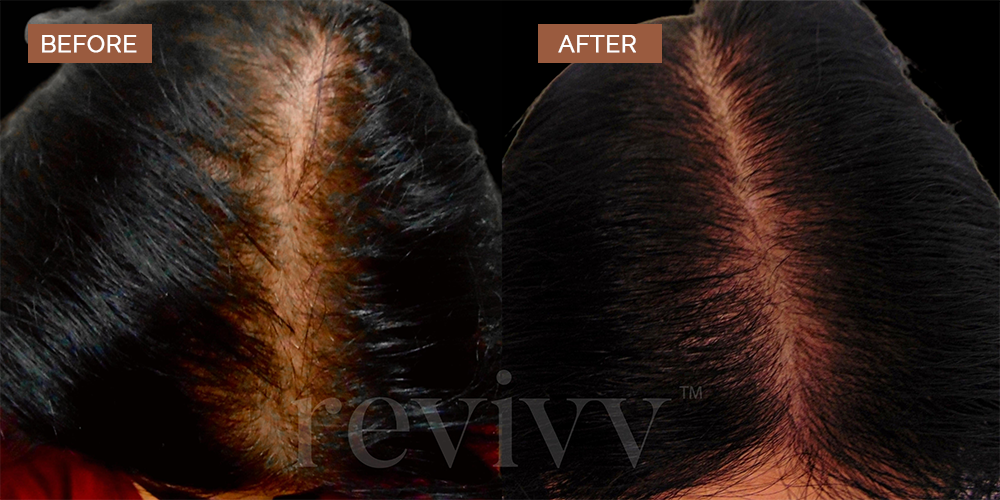 Revivv™ | Men and Women Hair Growth UAE and Saudi Arabia