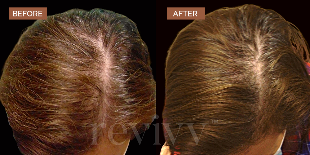 Revivv™ | Men and Women Hair Growth UAE and Saudi Arabia