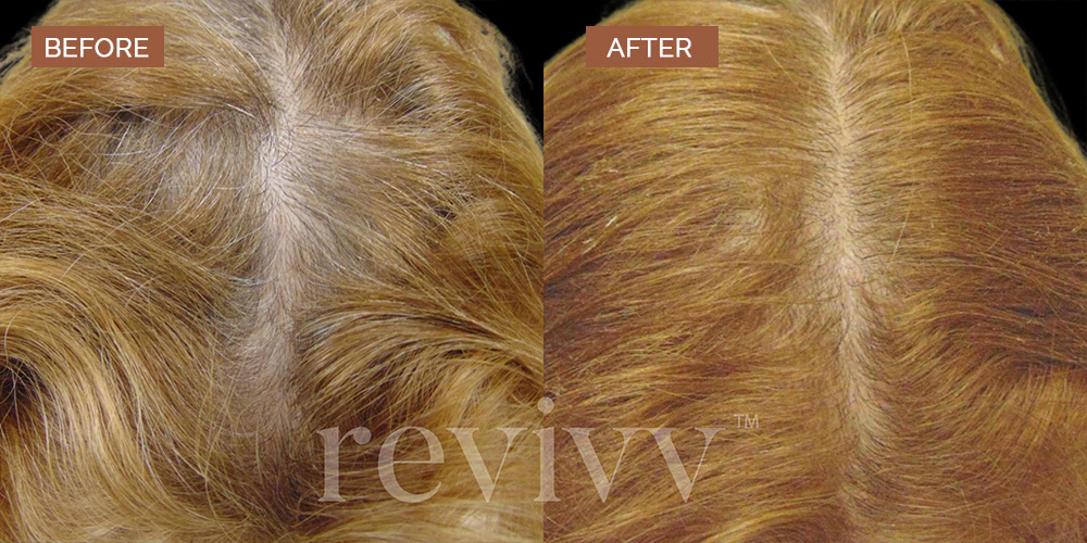 Revivv™ | Men and Women Hair Growth UAE and Saudi Arabia