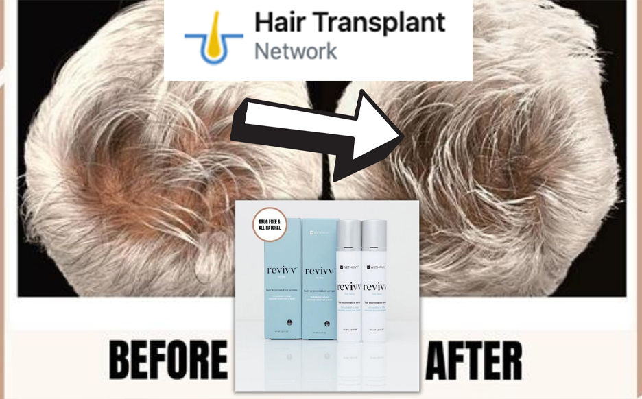 Featured On Hair Transplant Network