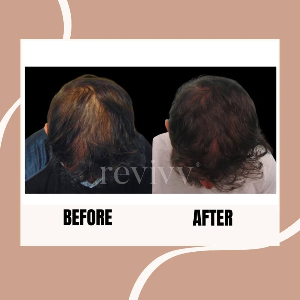 revivv-before-and-after-2-1024x1024.png